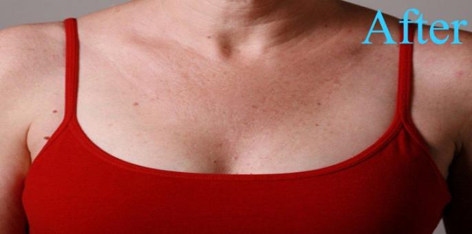 Prevent chest wrinkles - Get yourself the investment of the life time